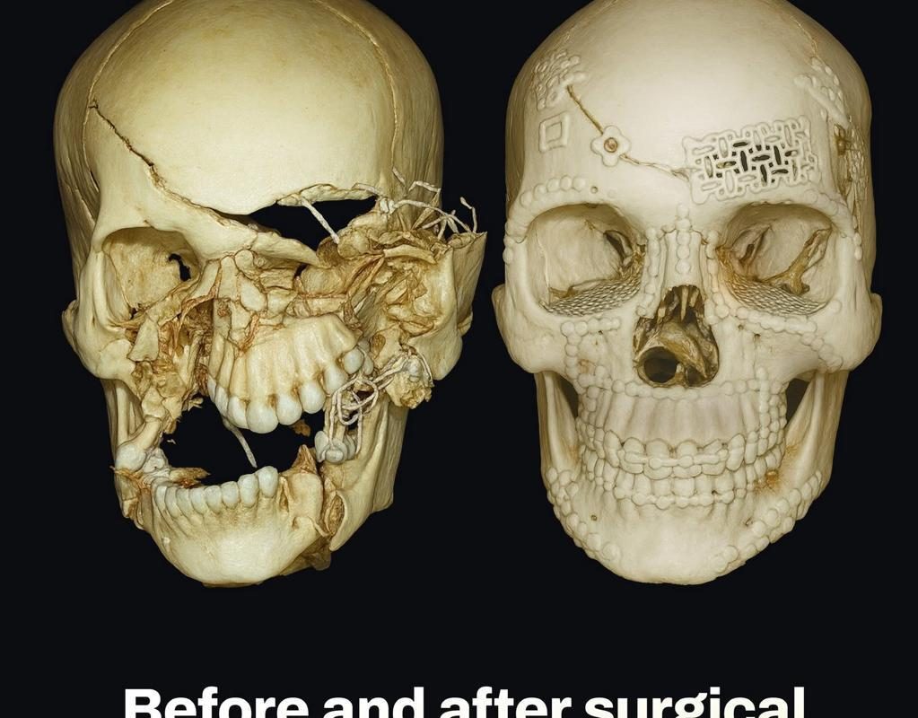 Before and after surgical repair of skull fractures from an accident.