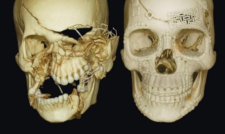 Before and after surgical repair of skull fractures from an accident.