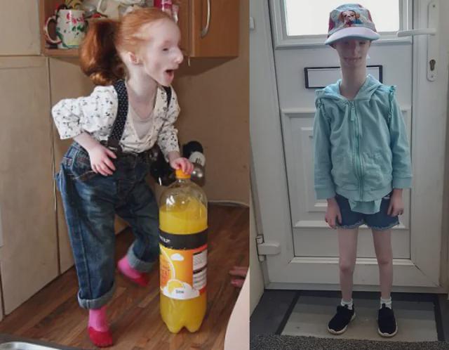 Charlotte Garside, the girl with primordial dwarfism who was said would never grow over 2 feet is now 4 feet tall