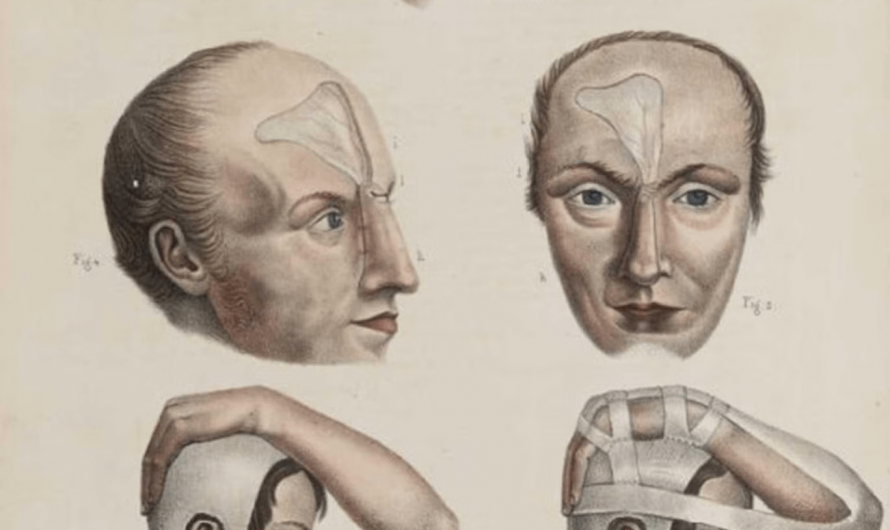 Early surgery methods to reconstruct a nose, From the book “Iconografia d’anatomia”, 1841