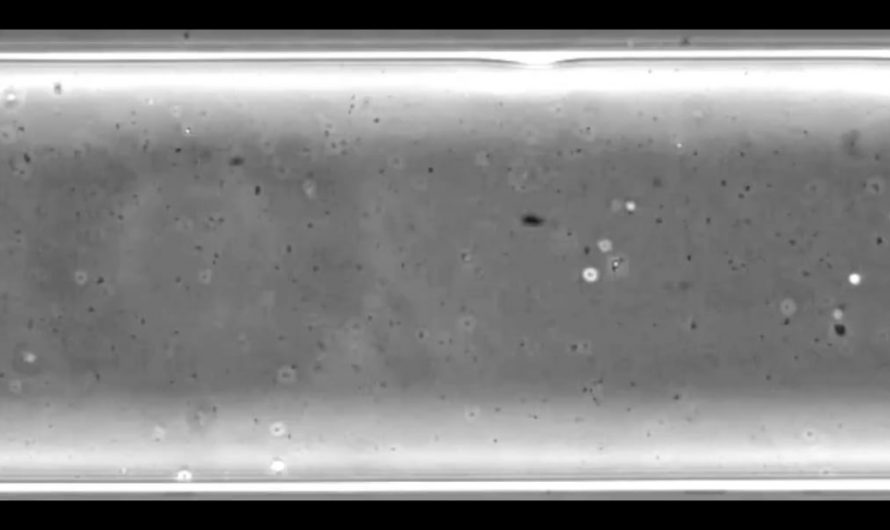 The 1st pregnancy via A.I. detected sperm (by finding 5 motile sperm in 2.5 million images) from a 39-year-old man with infertility.