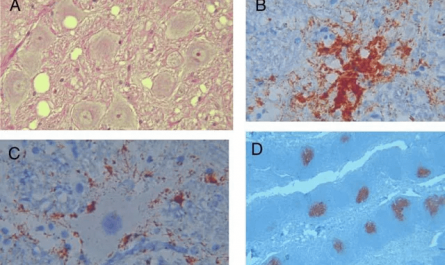 Two deer hunters from the same lodge both developed fatal sporadic CJD (Creutzfeldt-Jakob Disease) after exposure to CWD-infected deer. Sporadic CJD normally affects only 1-2 people per million annually. This is the first documented case linking humans to potential CWD transmission.