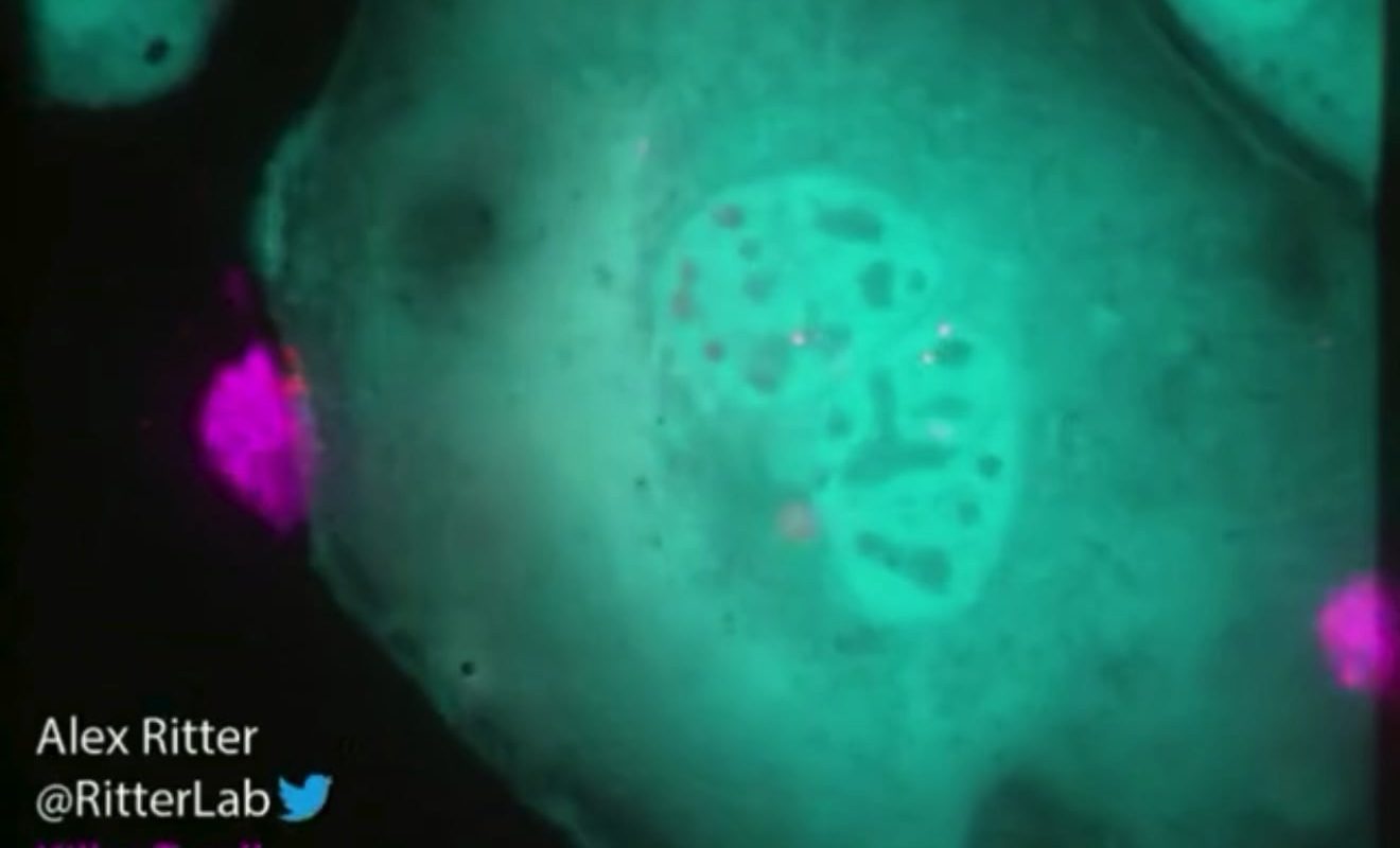 Watch a killer T cell of the immune system destroying a monstrous ovarian cancer cell. [Alex Ritter]