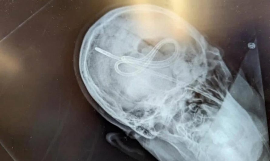 A rare but catastrophic medical error..an improperly placed nasogastric (NG) tube perforated the skull instead of entering the stomach. The case is now often cited in medical training to show why older ‘air bolus’ placement checks are unsafe and why X-ray or pH confirmation is mandatory today.