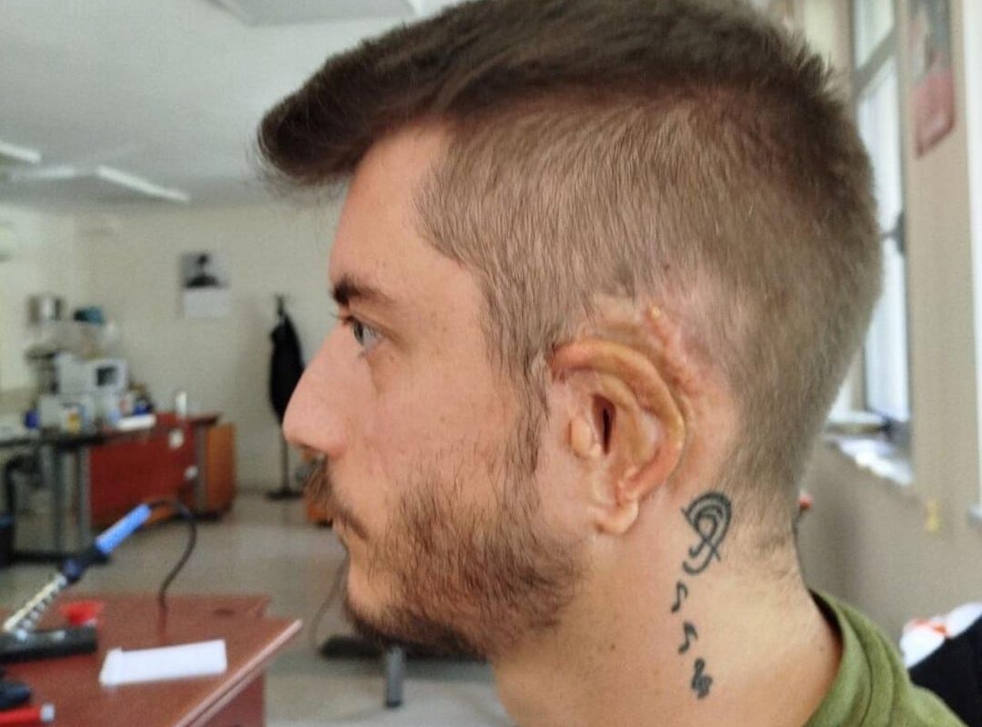 After 19 surgeries since 1996 for Grade 3 Microtia, I’m finally using modern tech to reach the finish line. A Medpor ear reconstruction and a Bionic Brainstem Implant (ABI) to finally hear the world in stereo for the first time at age 30. [OC]