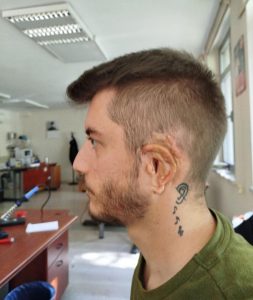 After 19 surgeries since 1996 for Grade 3 Microtia, I’m finally using modern tech to reach the finish line. A Medpor ear reconstruction and a Bionic Brainstem Implant (ABI) to finally hear the world in stereo for the first time at age 30. [OC]