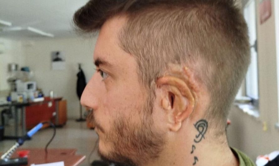 After 19 surgeries since 1996 for Grade 3 Microtia, I’m finally using modern tech to reach the finish line. A Medpor ear reconstruction and a Bionic Brainstem Implant (ABI) to finally hear the world in stereo for the first time at age 30. [OC]