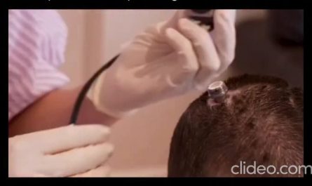 After losing her ability to speak due to a stroke, a woman received a brain implant that captures signals from the area of the brain responsible for planning speech. AI decodes these signals and transforms them into spoken words through a digital avatar, enabling her to communicate again.