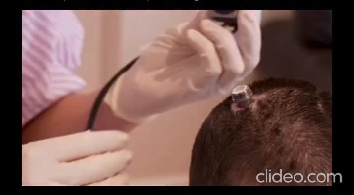 After losing her ability to speak due to a stroke, a woman received a brain implant that captures signals from the area of the brain responsible for planning speech. AI decodes these signals and transforms them into spoken words through a digital avatar, enabling her to communicate again.