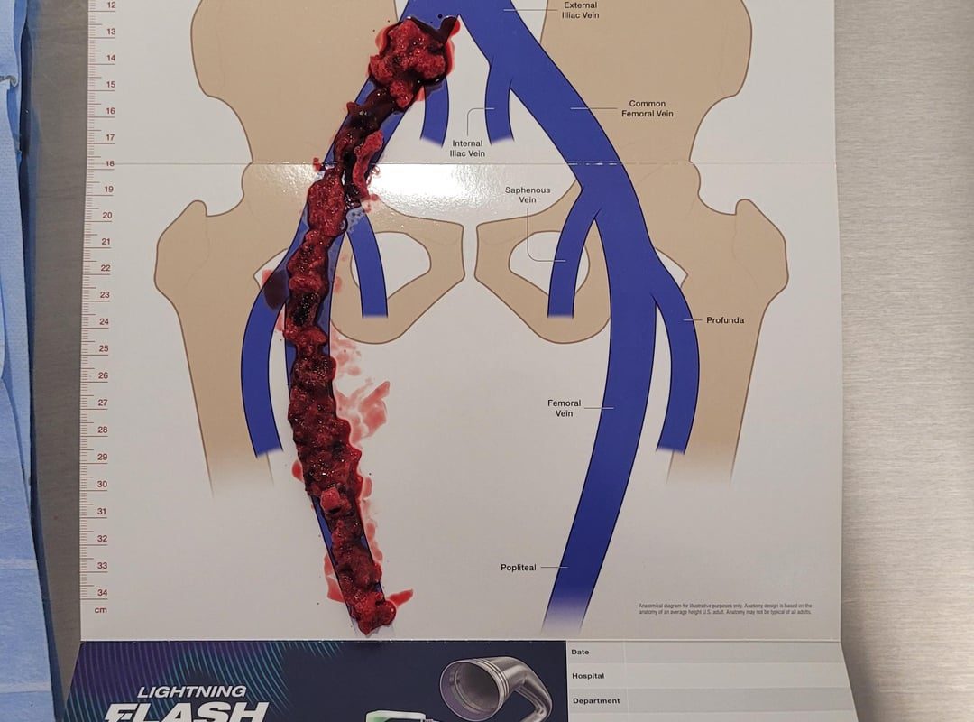 Doctors pulled this massive clot out of my leg today. (Surgeons had no bananas on hand, sorry).