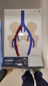 Doctors pulled this massive clot out of my leg today. (Surgeons had no bananas on hand, sorry).