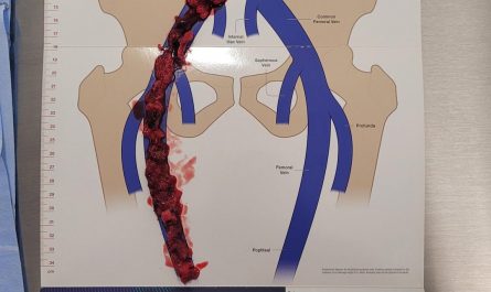 Doctors pulled this massive clot out of my leg today. (Surgeons had no bananas on hand, sorry).