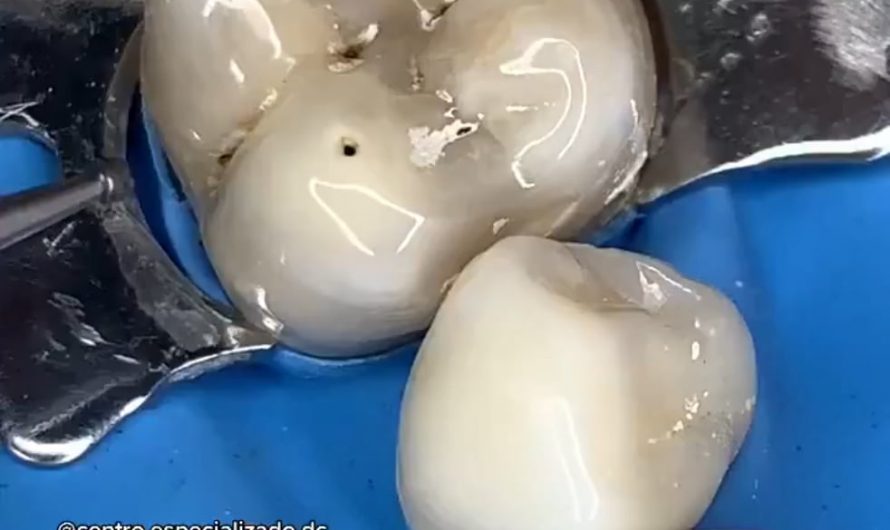 Drilling out tooth decay.