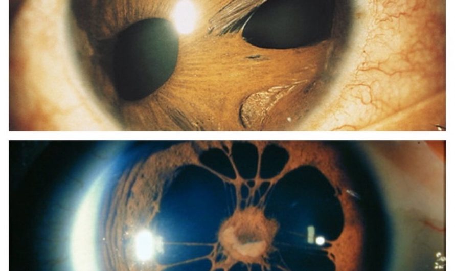 Eyes with Polycoria, an extremely rare eye condition.