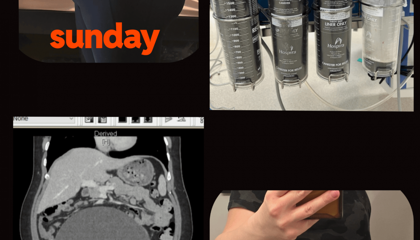 I had a 6 liter ovarian cyst surgically drained and removed.