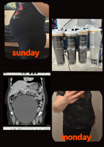 I had a 6 liter ovarian cyst surgically drained and removed.