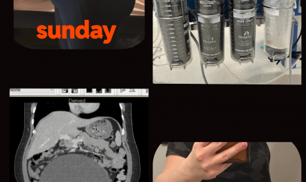 I had a 6 liter ovarian cyst surgically drained and removed.