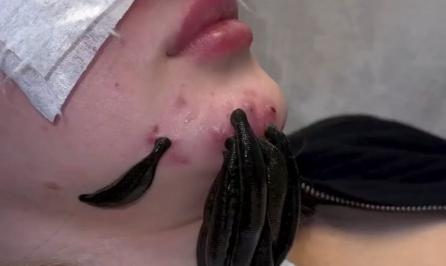 In hirudotheraphy, leeches may be used to assist in the treatment of abcesses, arthritis, glucoma, myasthenia gravis, thrombosis and some venous disorders. Medical leeches may also be used in plastic surgery and in some blood circulatory problems.