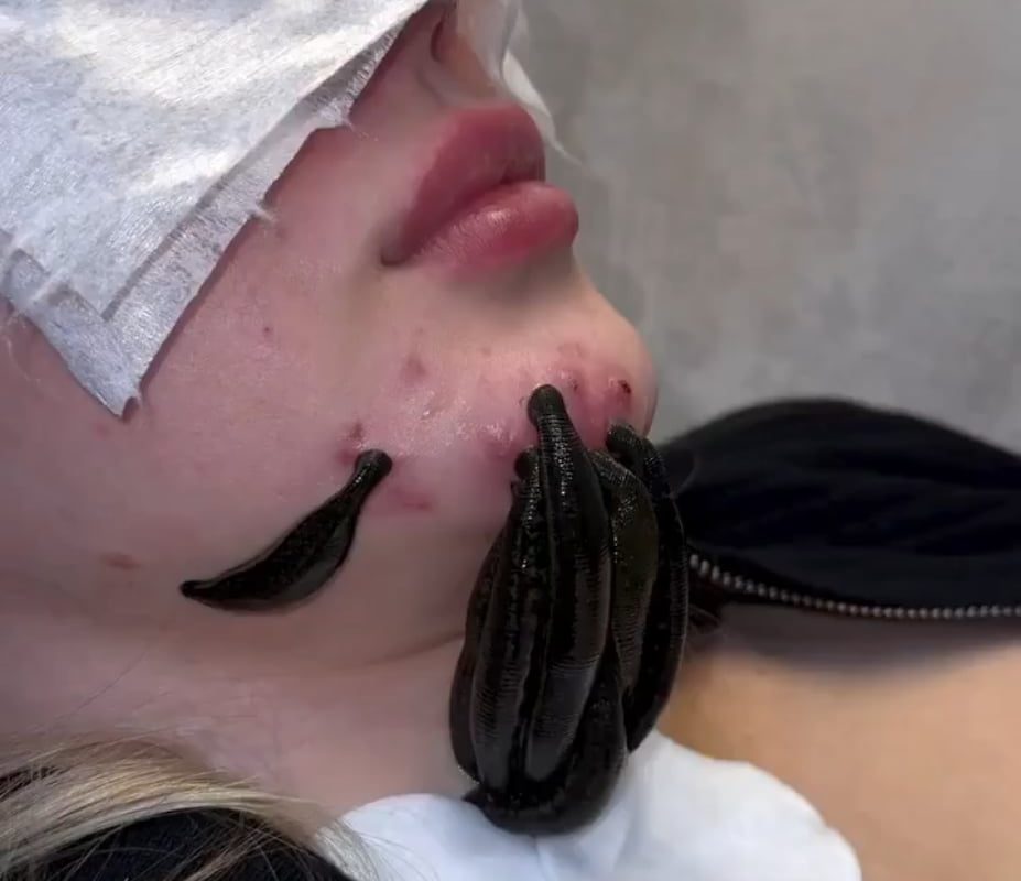 In hirudotheraphy, leeches may be used to assist in the treatment of abcesses, arthritis, glucoma, myasthenia gravis, thrombosis and some venous disorders. Medical leeches may also be used in plastic surgery and in some blood circulatory problems.