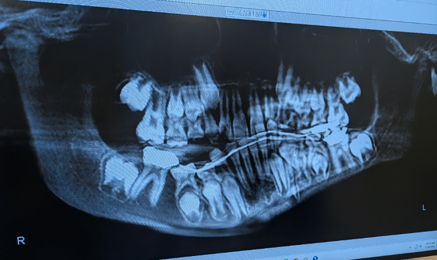 Most recent X-ray of my sons jaw