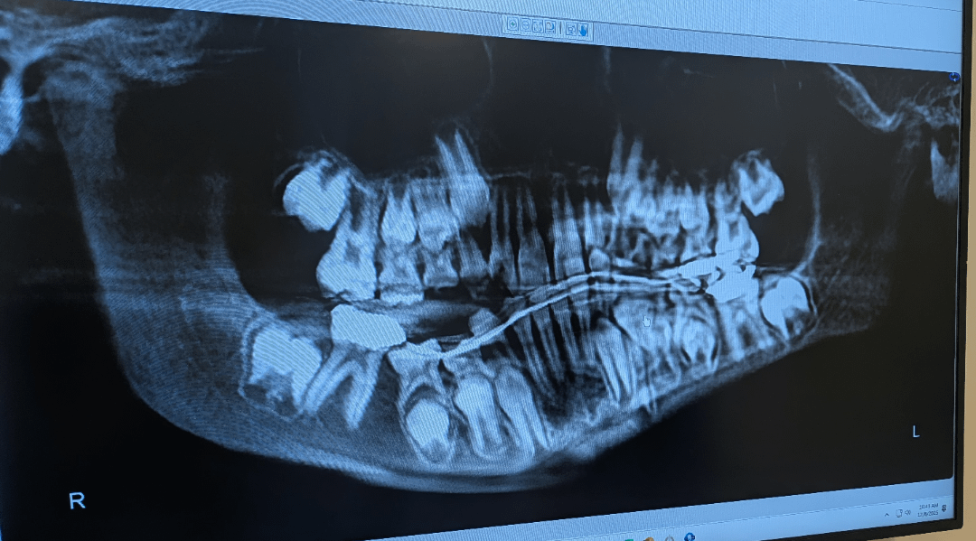 Most recent X-ray of my sons jaw