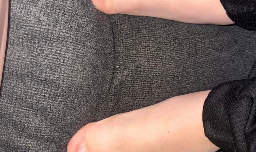 Multiple Webbed Toes (Couldn’t add to original post)