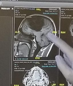 Over a third of my brain was removed