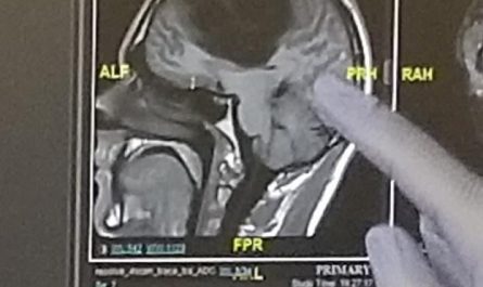 Over a third of my brain was removed