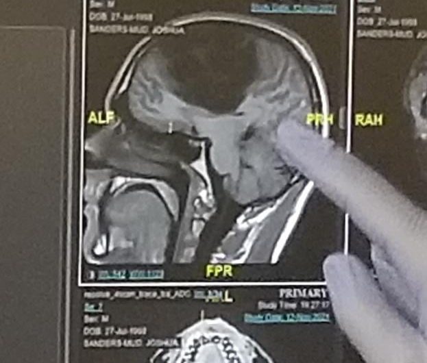 Over a third of my brain was removed