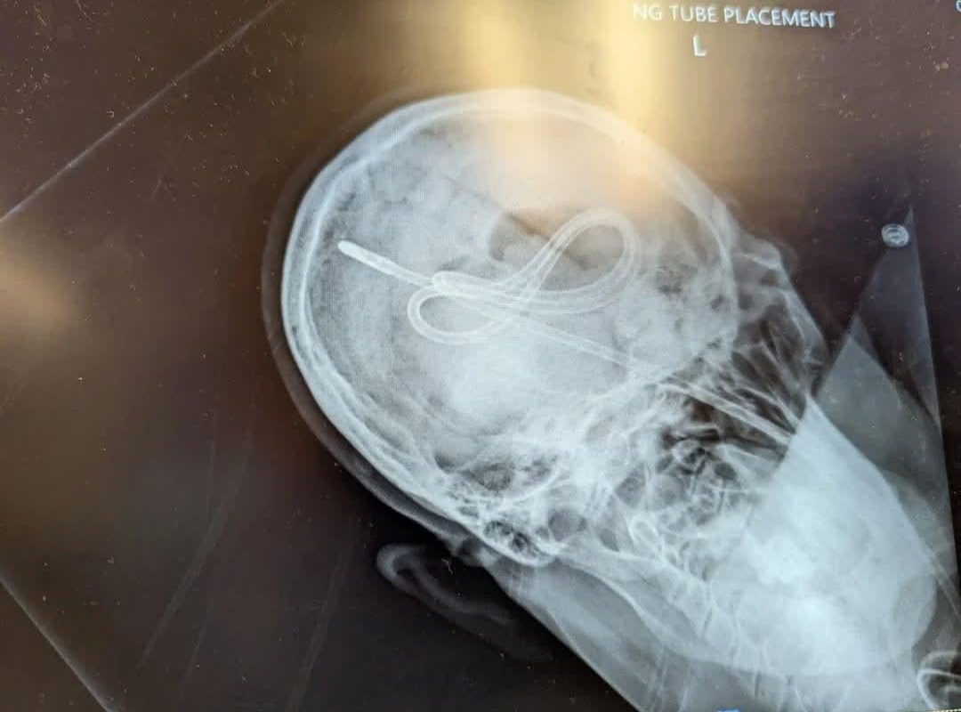 PMCT Images. Nurse advanced NG tube until she heard a pop, then tried an air bolus to ensure placement. Patient did not survive.