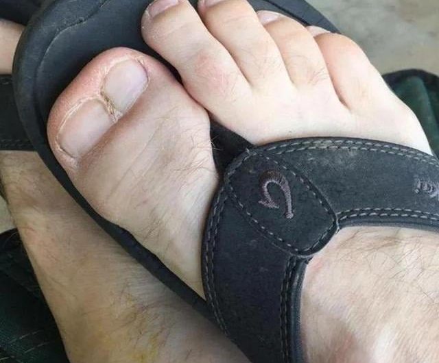 Polysyndactyly (or synpolydactyly) is a congenital condition combining polydactyly (extra fingers or toes) and syndactyly (webbed or fused digits).