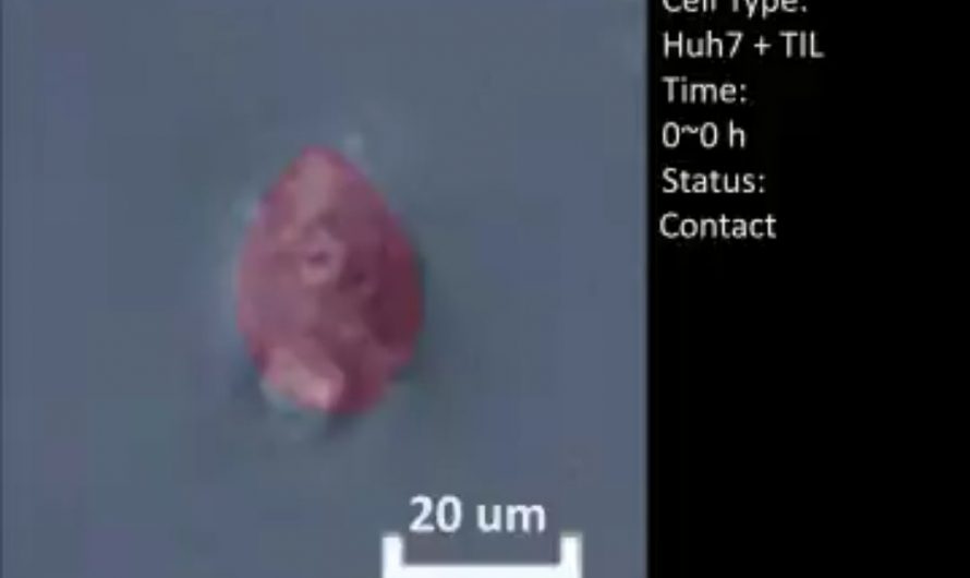 Real time video of tumor infiltrating lymphocytes attacking cancer cell.