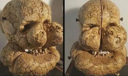 Skull of a man with Proteus syndrome.