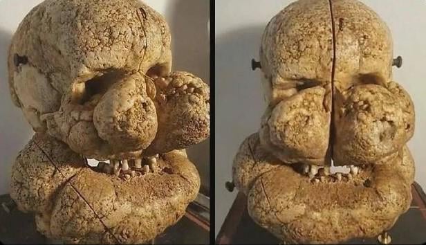 Skull of a man with Proteus syndrome.