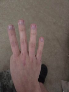 So my finger suddenly turn purple for no reason