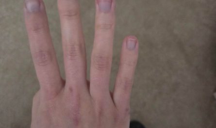 So my finger suddenly turn purple for no reason
