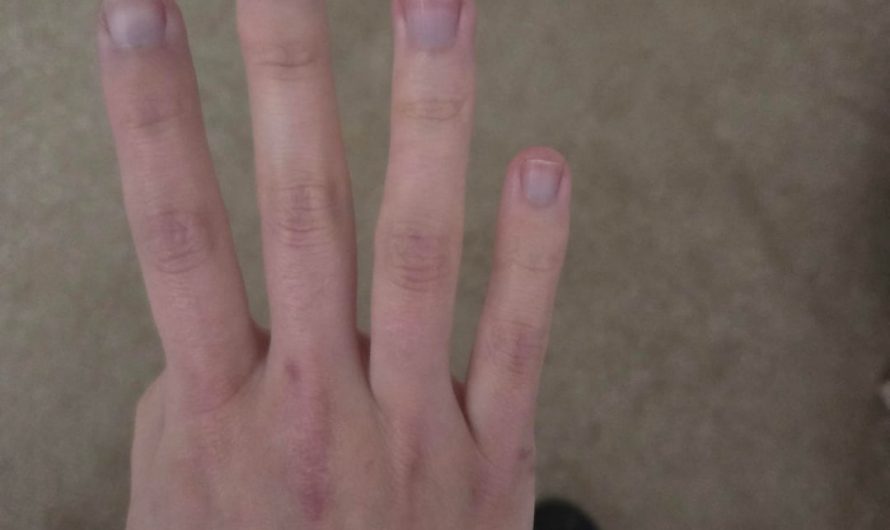 So my finger suddenly turn purple for no reason