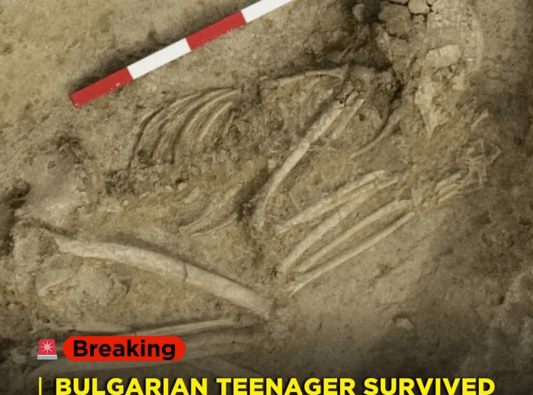 Teenager survived lion bite on the skull. More info in the first comment