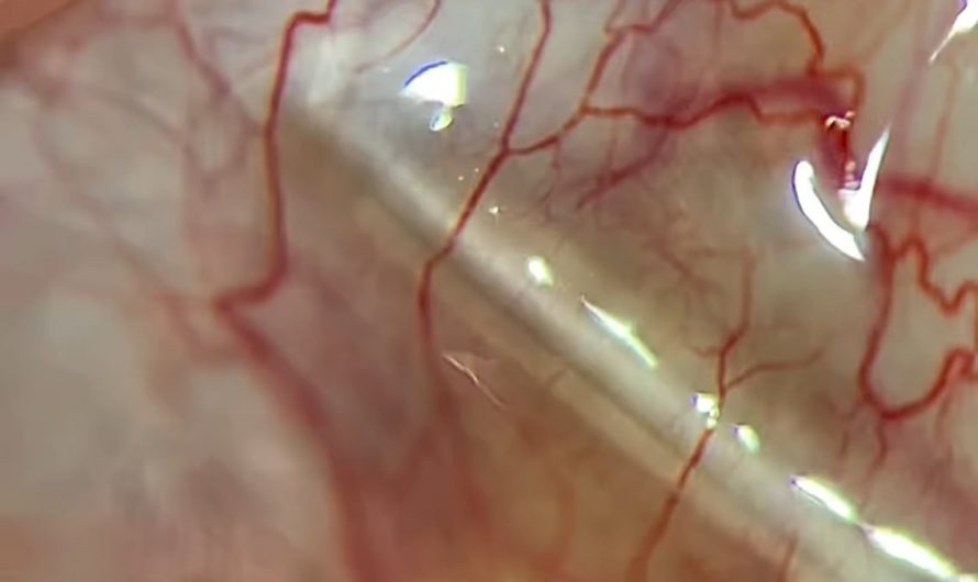 The eye is the most accessible places in the body to directly observe passage of the red blood corpuscles in a living person.