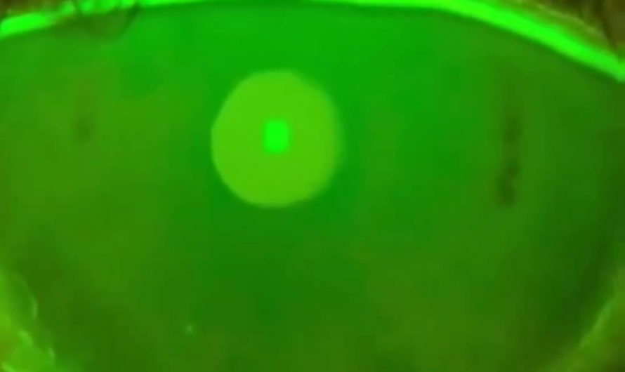 This is a tear break-up time (TBUT) test at 4× speed, showing the tear film thinning as evaporation drifts upward