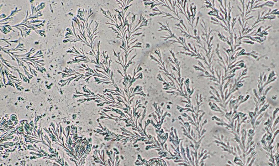 Vaginal secretions viewed under a microscope.