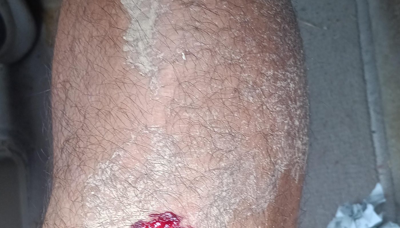 Well damn! I fell after having a negative thought and a cross formed as my bruise