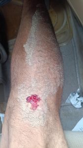 Well damn! I fell after having a negative thought and a cross formed as my bruise