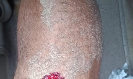 Well damn! I fell after having a negative thought and a cross formed as my bruise