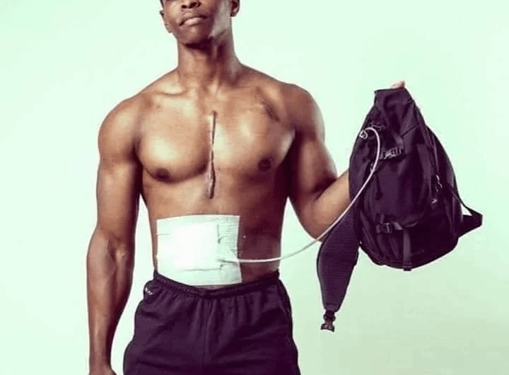Bodybuilder Andrew Jones (in 2016), who was suffering from heart failure, was taken to hospital for a transplant and instead came out with a mechanical heart device carried in a backpack, becoming known as the ‘fitness model without a pulse.’