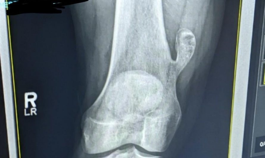 I’ve had a spare bone on my femur my whole life