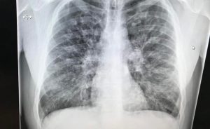Lungs of 33yo with Cystic Fibrosis, then days after a double lung transplant.