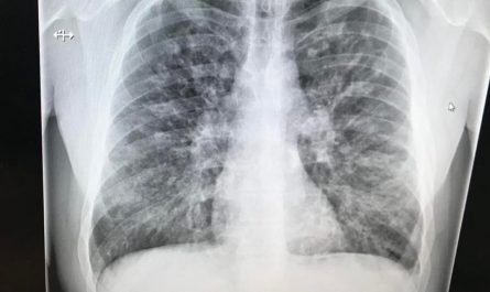Lungs of 33yo with Cystic Fibrosis, then days after a double lung transplant.