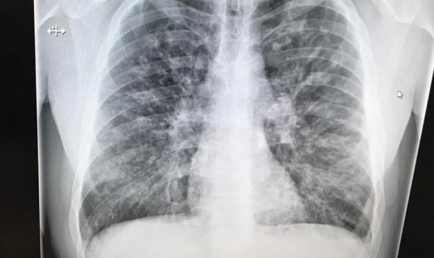 Lungs of 33yo with Cystic Fibrosis, then days after a double lung transplant.
