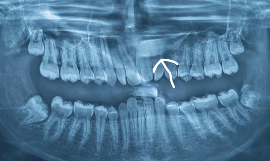 There’s a tooth sleeping in my gums peacefully and i never knew it until now